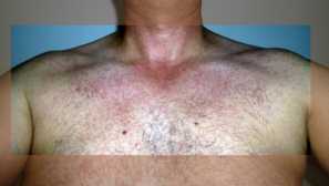 Dengue horečka - nosiče onemocnění, bojové komáry, symptomatika